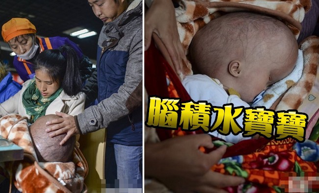 搶救強國腦積水寶寶 一家人住車上籌錢 | 華視新聞