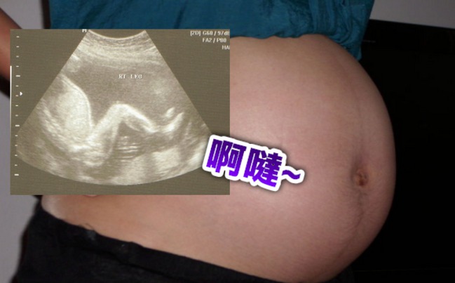 胎兒使出「無影腳」踹破媽媽子宮險喪命 | 華視新聞