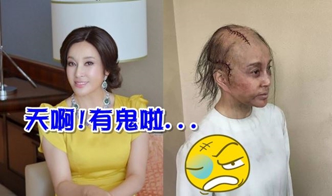 “逆齡美魔女”劉曉慶毀容了?! 禿髮傷疤嚇壞人 | 華視新聞
