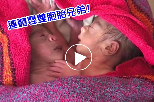 年輕女子產連體雙胞胎 雙頭4手2腳恐難活... | 華視新聞