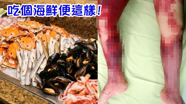 婦人吃海鮮 雙腿發紅起水泡險截肢! | 華視新聞