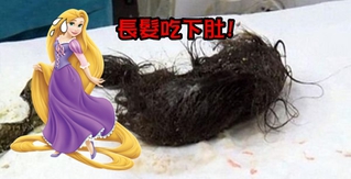 女童患「長髮公主病」 竟吃下1公斤頭髮!
