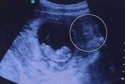 細看胎兒超音波照 你可能會毛毛的... | 右方出現像魔鬼的影像(翻攝英國鏡報)
