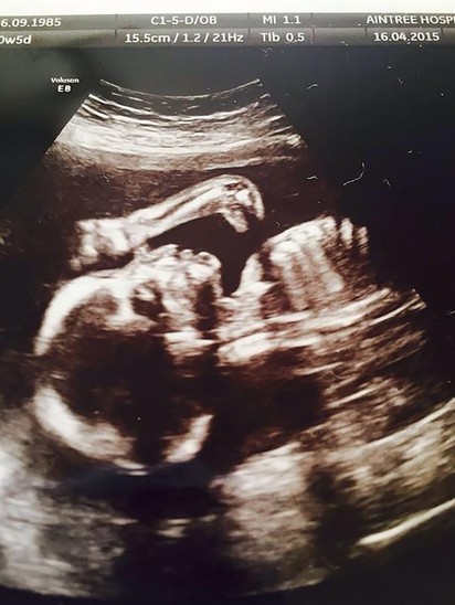 細看胎兒超音波照 你可能會毛毛的... | 胎兒上方驚見一個像恐龍的圖像(翻攝英國鏡報)