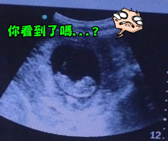 細看胎兒超音波照 你可能會毛毛的... | 華視新聞