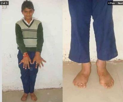 印度父子好驚人! 手指加腳趾一共52根 | 哈許遺傳老爸也有多指症。