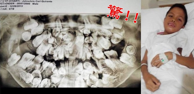 多齒症長300顆牙 菲國9歲童嘴巴塞爆了 | 華視新聞