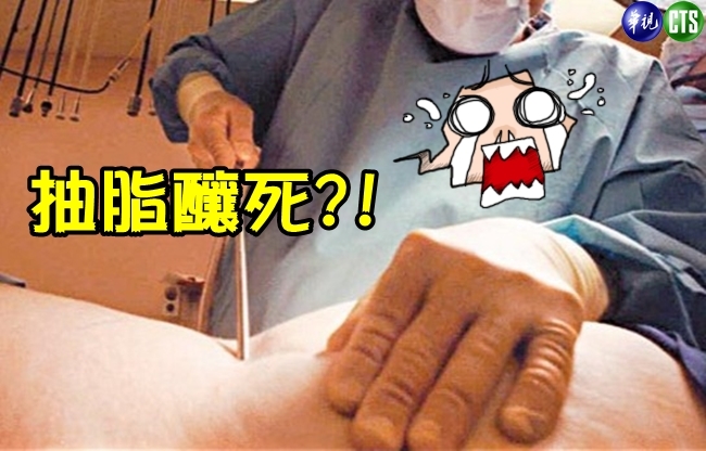 【華視最前線】婦人抽脂疑腸穿孔 併發敗血症死亡! | 華視新聞