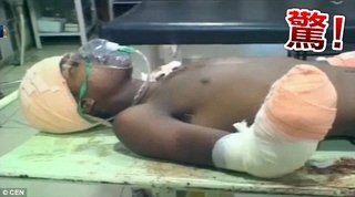 性侵女嬰 印度17歲少年被女嬰父砍斷雙手