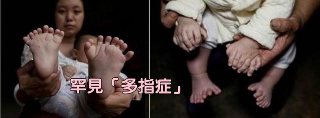 多指症怪病 男嬰15隻手指16隻腳趾 | 華視新聞