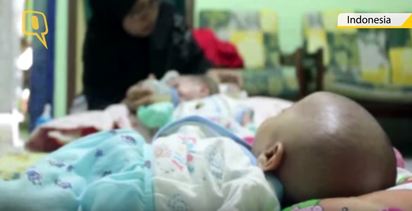 印尼婦產下三胞胎 2個寶寶頭殼相連 | 三胞胎另一名寶寶很正常.