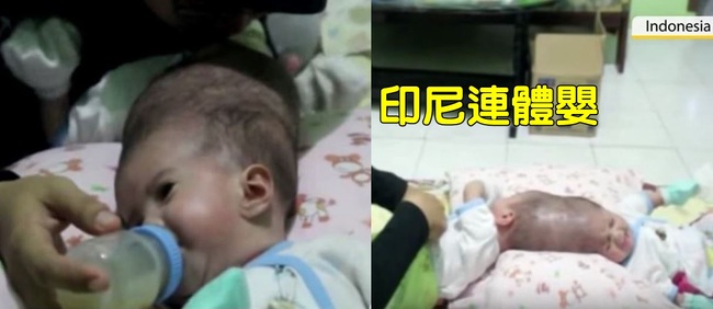 印尼婦產下三胞胎 2個寶寶頭殼相連 | 華視新聞