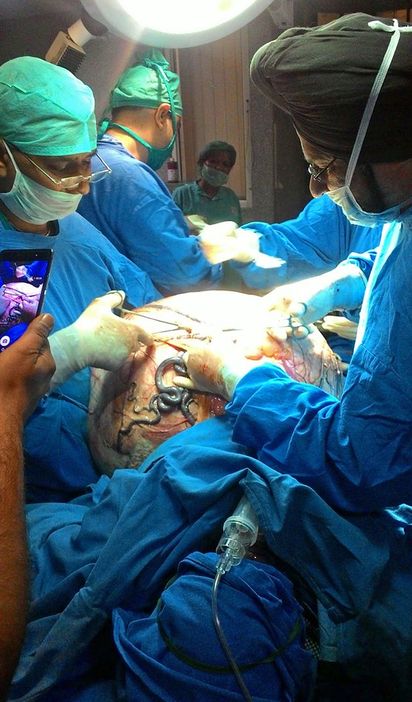 慎入! 印度婦割除97公斤驚人卵巢瘤 | 醫師替她從肚子取出卵巢瘤