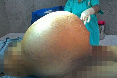 慎入! 印度婦割除97公斤驚人卵巢瘤 | 