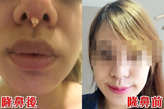 正妹隆鼻驚悚穿出異物 流黃膿怒嗆:不聞不問! | 華視新聞