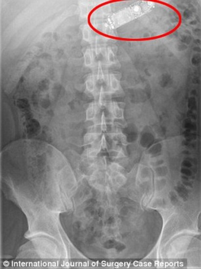 扯! 醫生幫他照X光 在肚裡發現"手機" | (翻攝每日郵報)
