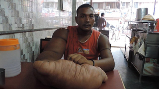 男擁20公斤巨手 被指"惡魔之子"逐出家鄉