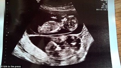 超罕見! 她懷孕期間竟又懷了另一胎 | 兩胚胎受精卵時間估相距10天以上(翻攝每日郵報)