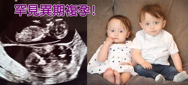 懷孕再懷孕! 罕見「異期複孕」誕下龍鳳胎 | 華視新聞