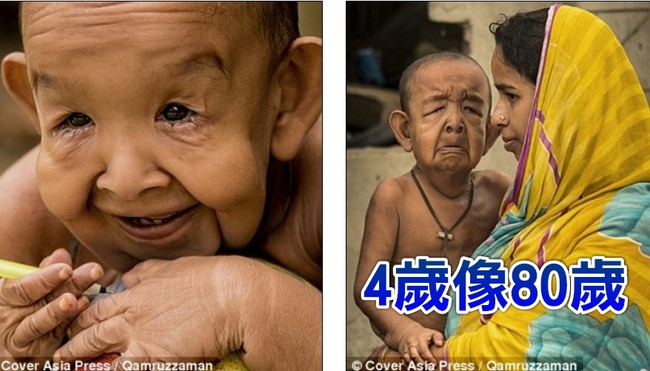 「4歲像80歲」 罕病男童如真實版《班傑明》 | 華視新聞