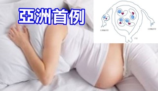 亞洲首例! 吃排卵藥婦人5胞胎異位懷孕
