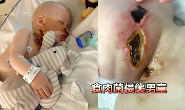 要命食肉菌! 男童水痘感染險喪命 | 華視新聞