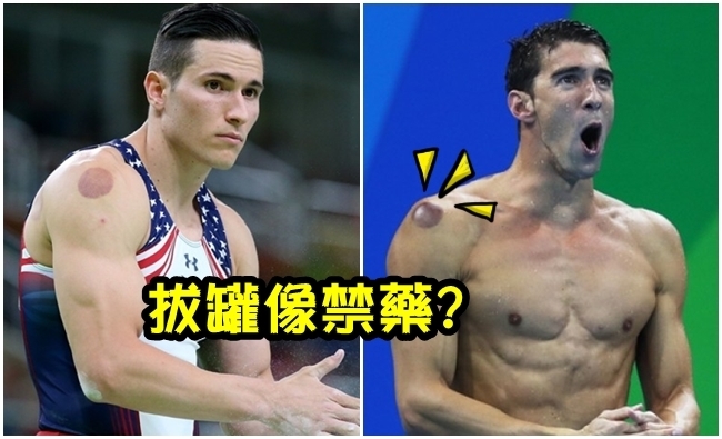 奧運選手拔罐 俄羅斯怒控"跟禁藥一樣"?! | 華視新聞