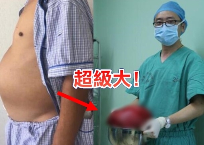 男子肚腫像懷孕 開刀竟取出8公斤肉瘤 | 華視新聞