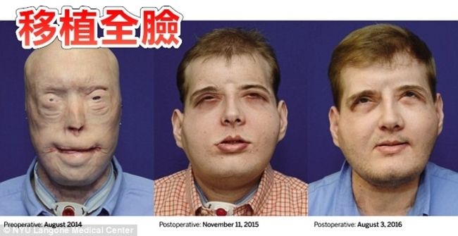 真人版變臉! 消防員移植整臉重拾自信 | 華視新聞
