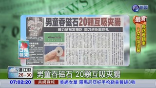 男童吞磁石 20顆互吸夾腸