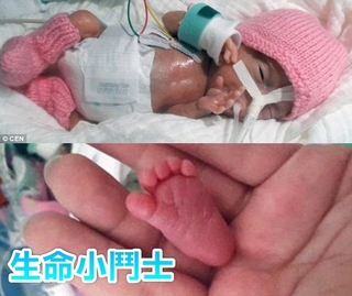 拇指公主! 全球最小新生兒 僅226公克