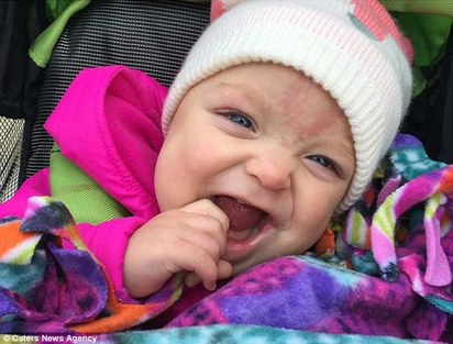 「巨舌女嬰」動手術  終於能開心笑了 | 接受手術後 她終於能正長的笑了!