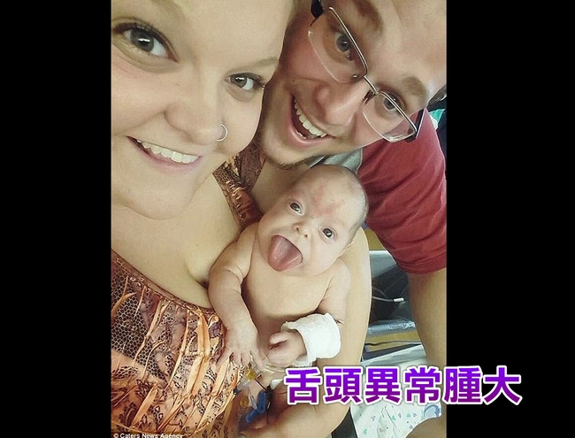 「巨舌女嬰」動手術  終於能開心笑了 | 華視新聞
