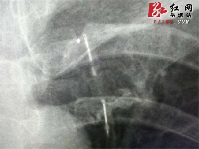 繡花針藏體內 卡4歲女心肺險奪命 | 華視新聞