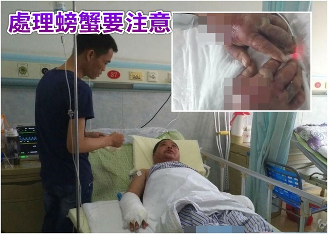 料理螃蟹被鉗夾傷 陸男雙手腫脹險喪命 | 華視新聞
