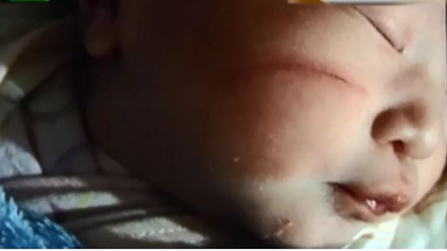 扯!剖腹產女嬰臉留刀疤 醫師:產婦肚皮薄 | 華視新聞