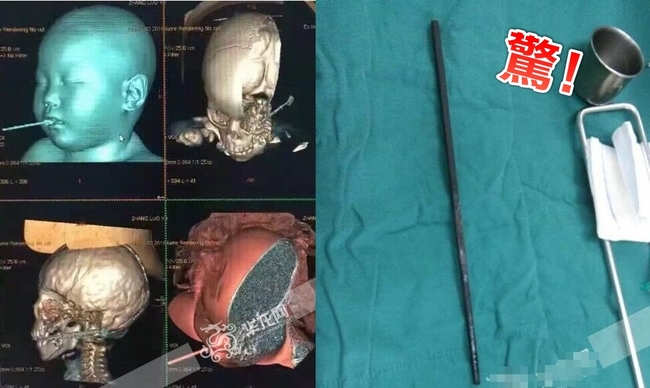 驚! 男童跌倒筷子插喉嚨 離頸動脈僅2mm | 華視新聞