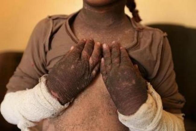 受IS化學武器汙染 女童皮膚病變起怪疹 | 華視新聞
