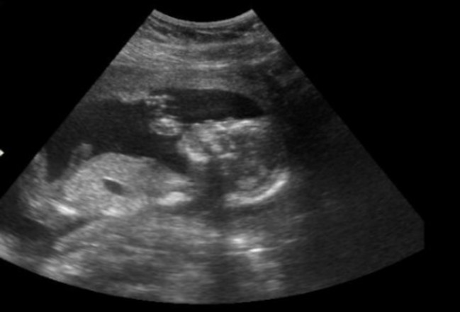 驚悚! 4月胎不幸小產 竟將"胎屍"放冰箱凍1年 | 華視新聞