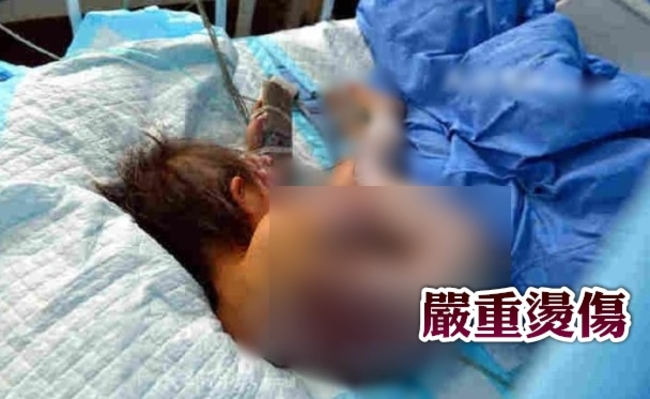 2歲女童跌熱水鍋 全身40%燒燙傷 | 華視新聞