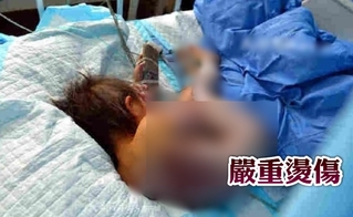 2歲女童跌熱水鍋 全身40%燒燙傷