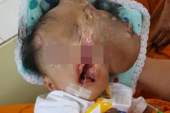 泰女嬰出生就無頭骨 僧侶幫募款助就醫 | 華視新聞