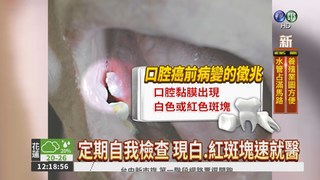 假牙不合頻摩擦 8旬婦罹口腔癌