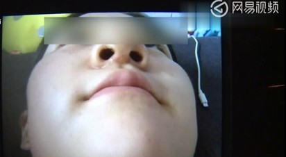 19歲女隆鼻失敗 假體竟從鼻孔露出! | (翻攝網易視頻)