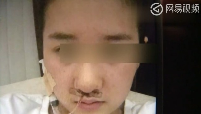 19歲女隆鼻失敗 假體竟從鼻孔露出! | 華視新聞
