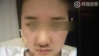 19歲女隆鼻失敗 假體竟從鼻孔露出!