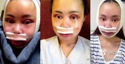 重慶Angelababy爆紅 只因一篇整容日記 | 包括了雙眼皮、臉部脂肪填充等等。