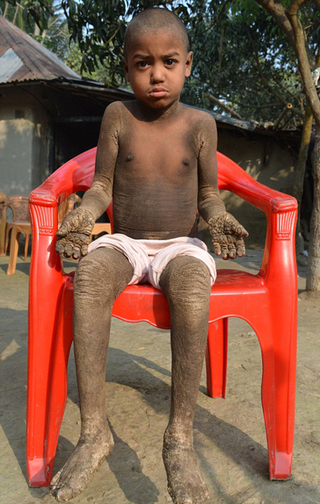 孟加拉男童患罕病 全身長滿灰鱗片!