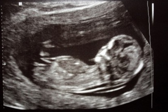 懷胎3月發現有缺陷要生嗎? 網友全都這樣說.. | 華視新聞