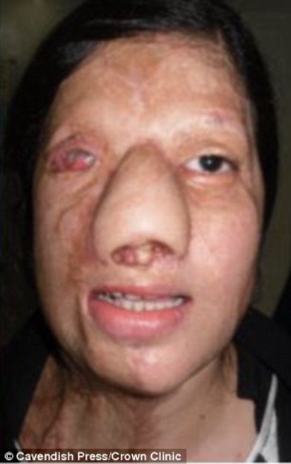正妹空姐遭閨密毀容 10年重建尋獲真愛 | 空姐的臉逐漸重建，醫生用她的大腿組織重建鼻子。。!翻攝自《每日郵報》。